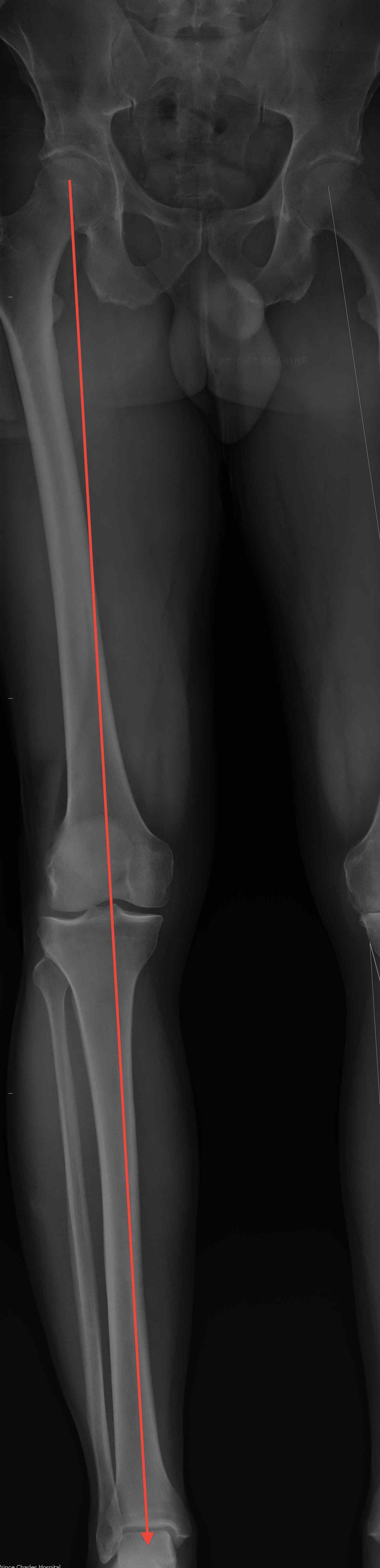 Mechanical Axis Lower Limb